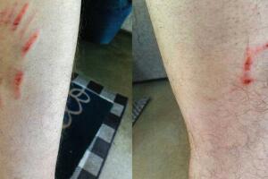 dog bite injury 5_22.jpeg