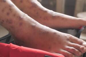 Foot with ulcer filled with pus condition caused of scabies infection, sensitive skin itchy health problem