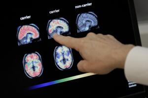 Medicare Alzheimer Brain Scans