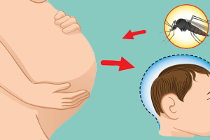 zika-causa-microcefalia.png