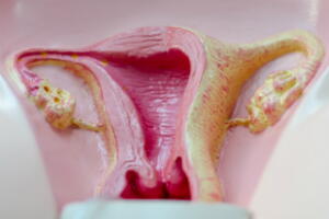 cirurgia-para-mioma-1.jpg