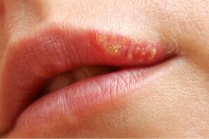 herpes-labial-oral-0218-1400x800.jpg