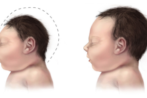 Comparación de la cabeza de un niño con microcefalia y otro que no padece la enfermedad
