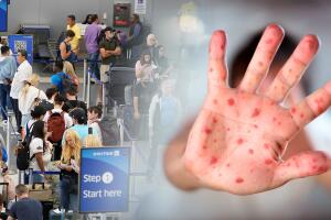 ¿Qué hacer en caso de exposición al sarampión? Estos son los síntomas