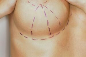 cirurgia-plastica-verao-2.jpg
