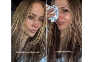 Así apareció Jennifer López con el rostro lesionado.