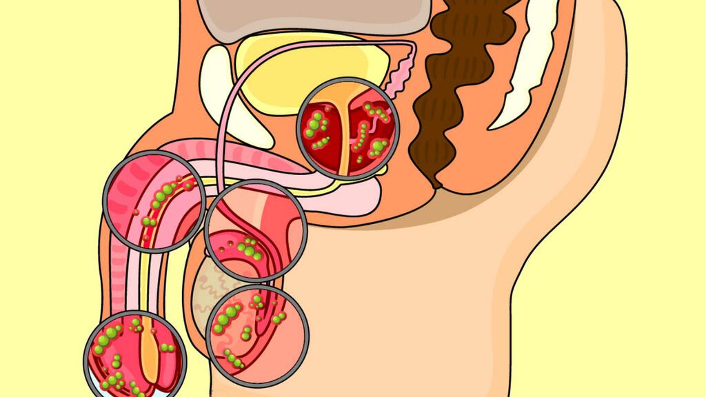 son candidiasis candidiasis causadas por alimentos