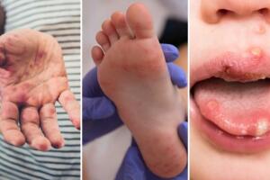 virus mano boca pie brote escuelas niños condado hidalgo