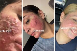 collage_historia_acne_severo.jpg