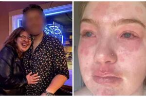 Joven alérgica a su novio viral.jpg