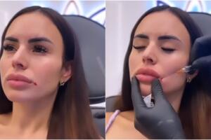 Evelyn Beltrán se despidió del relleno en sus labios.