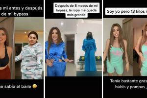 gomita antes y despues bypass gastrico tiktok.jpg