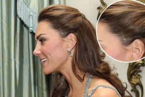 Kate Middleton scar