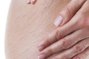 cirurgia-para-tirar-estrias-2.jpg