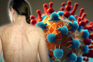 Posible exposición al sarampión en el restaurante Sons of Liberty de San Leandro el 9 de marzo. Los no vacunados y otros grupos de riesgo deben contactar a su proveedor de salud y al Departamento de Salud Pública del Condado de Alameda.