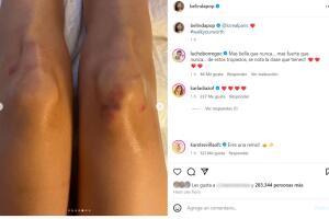 La cantante mostró las lesiones que le dejaron su caída.