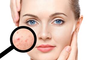 Cómo evitar que la piel grasosa brille