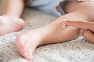 Mother applying cream on a girl's legs with red spot, blister. Medicine and health care concept.