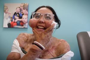 Un incendio le hizo perder las piernas, pero no las ganas de vivir