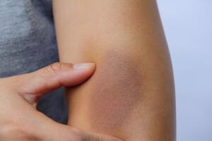 Los moretones o hematomas son síntoma de estas enfermedades