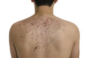 Como-tratar-el-lupus-2.jpg