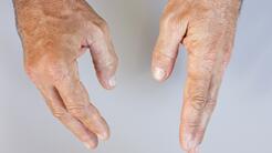 ¿Qué es el lupus?