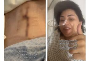 Gomita mostró la cirugía en la parte lateral de su abdomen