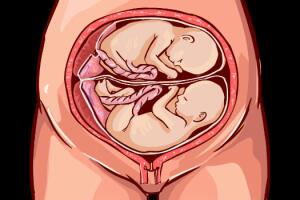 cordao-umbilical-enrolado-gemeas-3.jpg