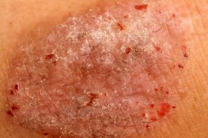 psoriase.jpg
