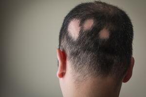 alopeciaareata.jpg