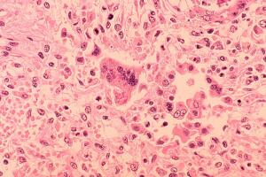 Casos de sarampión en Chicago: autoridades confirman 15 infecciones y revelan sitios de exposición