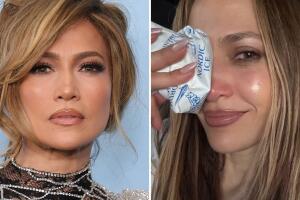 Jennifer Lopez aparece con fuerte lesión en rostro: tuvieron que suturarla ¿tras romperse la nariz?