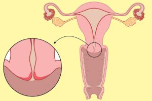 colo-do-utero.jpg