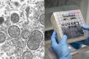 viruela del mono.jpg