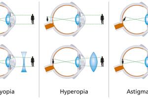 miopia.jpg