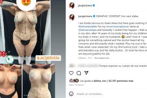 Este es el 'antes y después' definitivo del 'mommy makeover' de Jacqie Rivera.