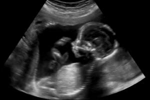 Sonografia