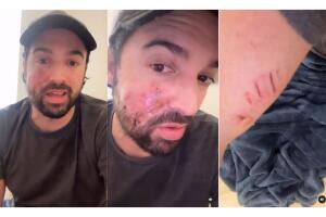 Carlos Girón se recupera tras ser mordido por un perro.