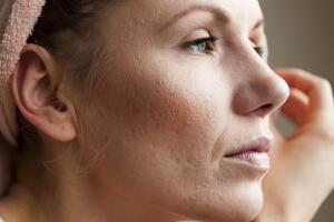 pele-acne-rosacea-1118-1400x800.jpg