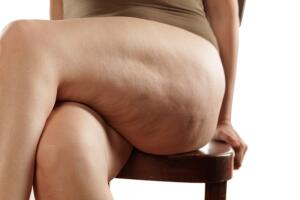 piernas-cruzadas-de-mujer-con-celulitis.jpg