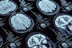 Resonancia magnética