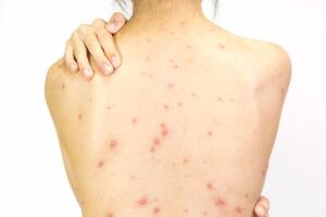 Closeup of girl back of Varicella virus or Chicken Pox on white 