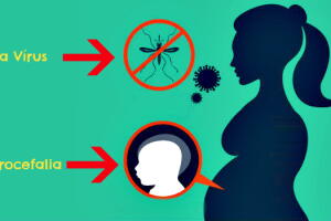 zika-causa-microcefalia-1.jpg