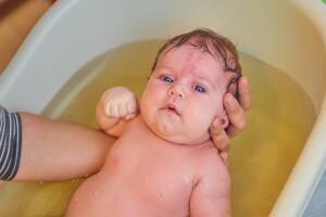 las manchas más comunes en los bebés