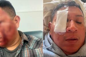 Javier Ibarra sufrió fracturas faciales, una laceración ocular y múltiples contusiones