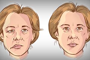 paralisia-facial-0717-1400x800.jpg