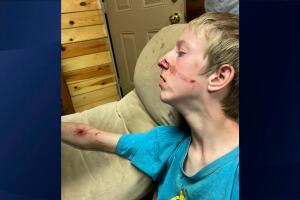 Brigham Hawkins sufrió heridas en el rostro y un brazo