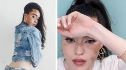 La modelo con vitíligo que triunfó al mostrar sus 'imperfecciones': Stephanie Yashimura