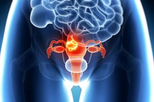 utero-cancer-0817-1400x800-2.jpg