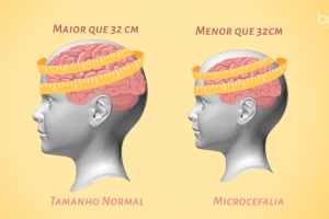 microcefalia_0_0.png